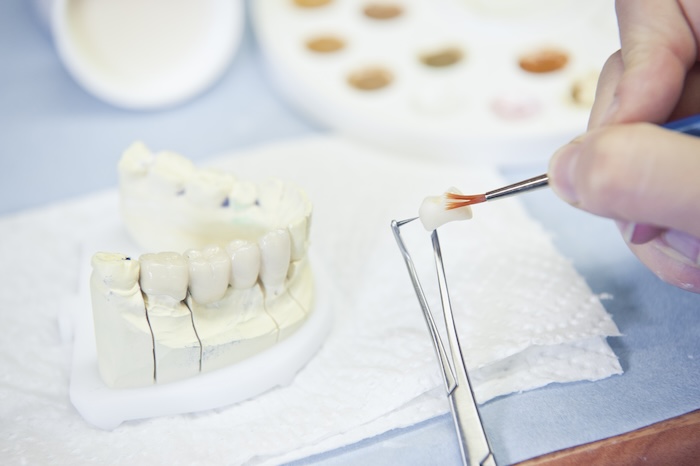 Inlays Zahntechniker München Dentallabor Citadelle