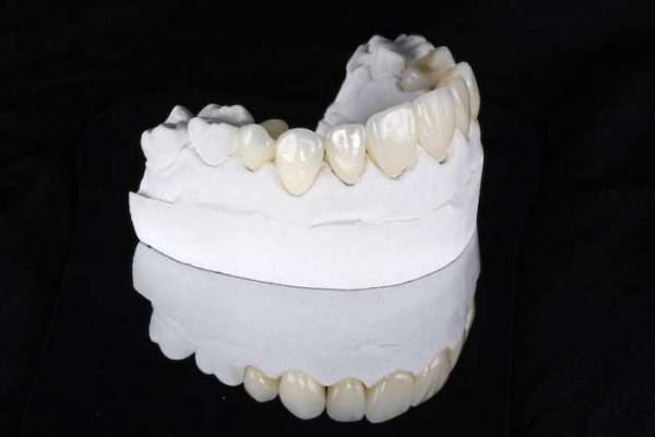 Veneers München Dentallabor Citadelle Gebissabdruck